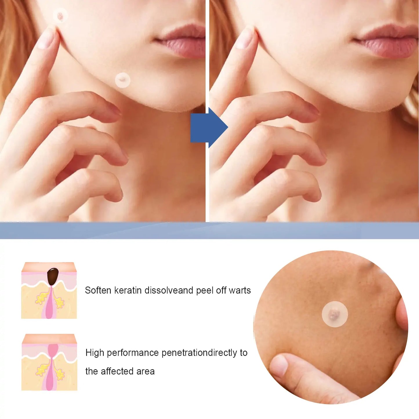 Invisible Blemish & Spot Cover Patch – Skin Sticker 144 pcs